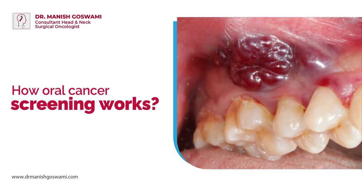 How Oral Cancer Screening Works?