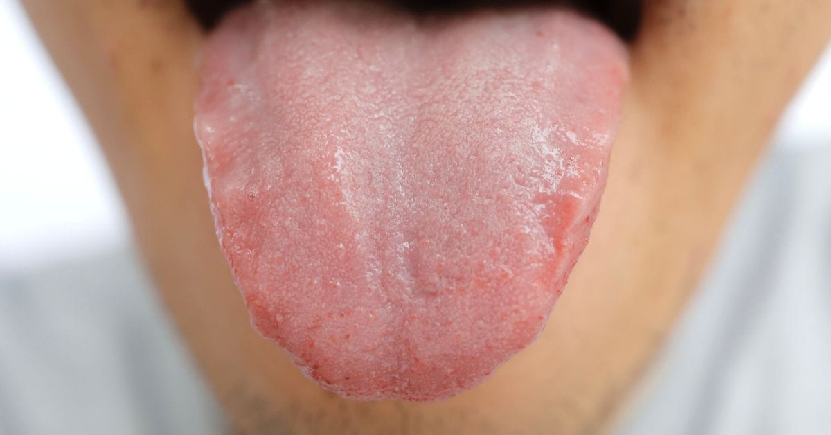 mouth cancer